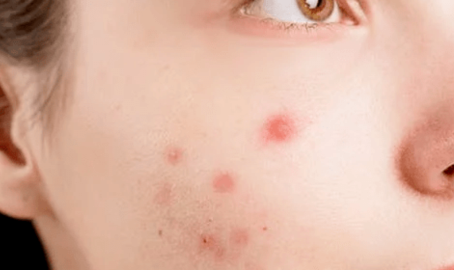 ACNE- causes, effects and treatments