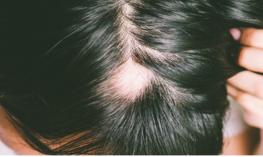 Alopecia Areata- A Common Hair Loss Condition