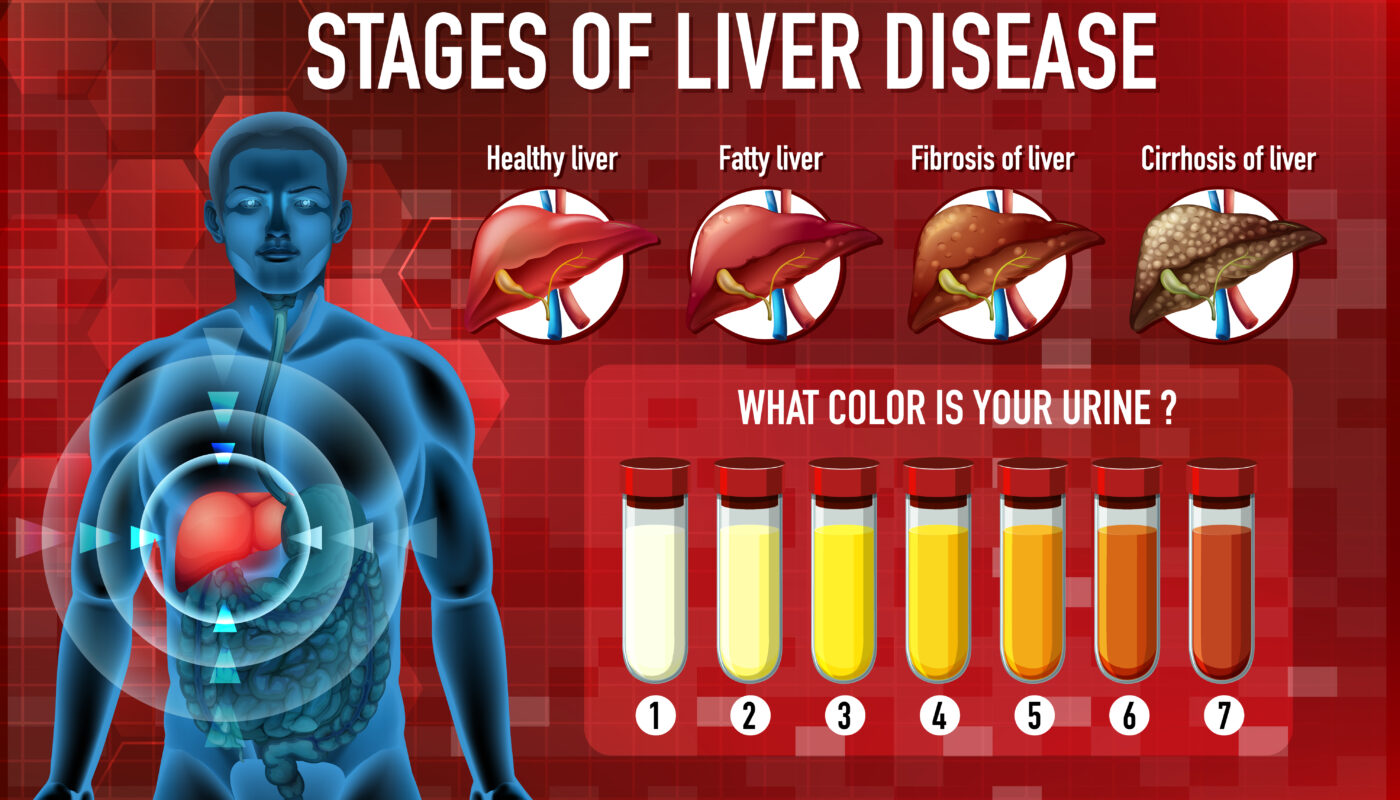 Hepatitis