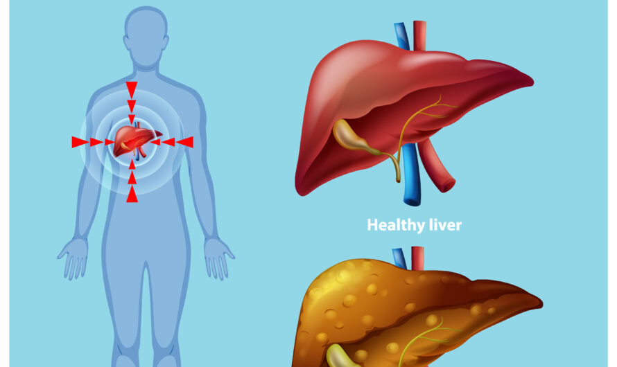 Hepatitis: Causes, Precautions, and More